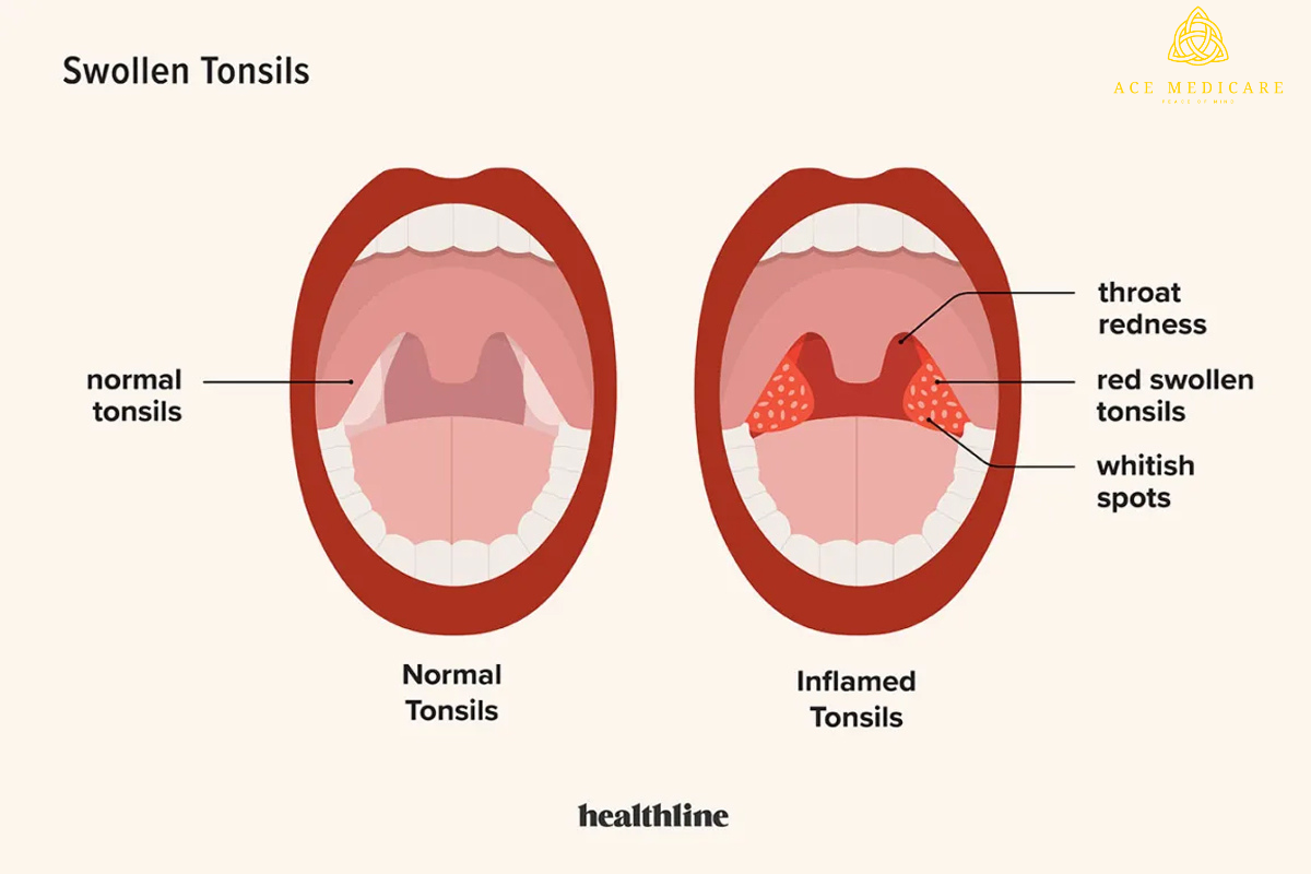 Understanding Tonsillitis: Causes, Symptoms, and Treatment